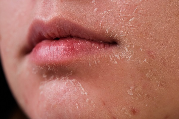 عوامل موثر در بروز خشکی پوست